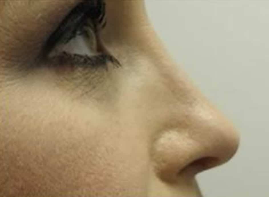 After Image: Nasal Reconstruction - right-side