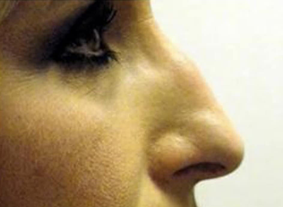 Before Image: Nasal Reconstruction - right-side