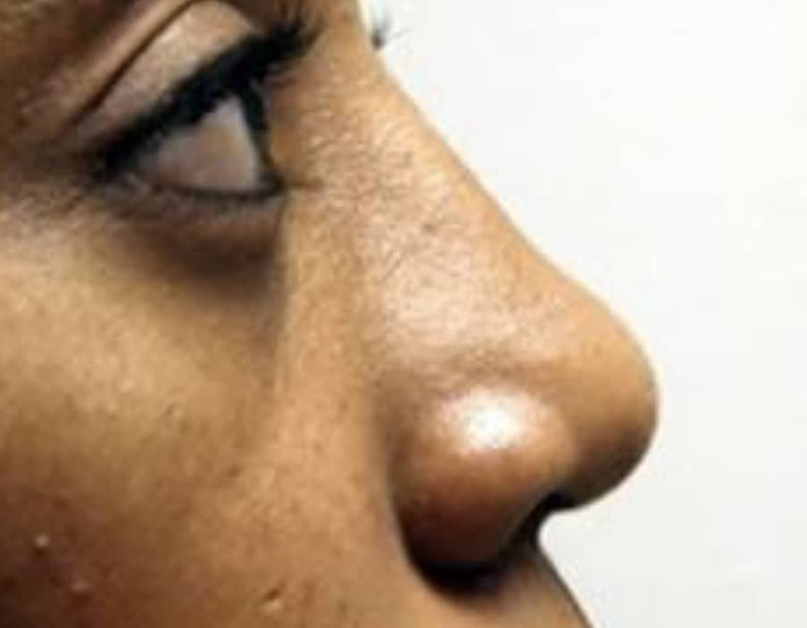 After Image: Nasal Reconstruction - right-side